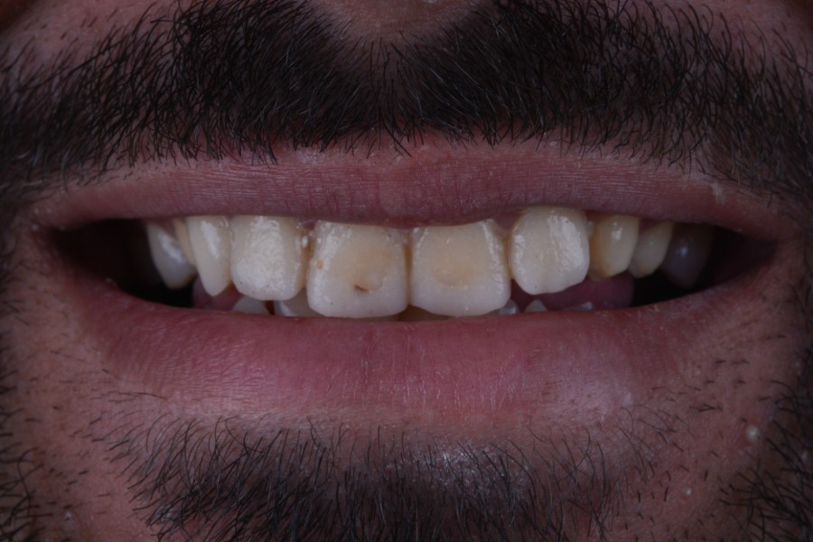 قبل تغير لون و شكل الأسنان لإعادة تأهيل الابتسامة.